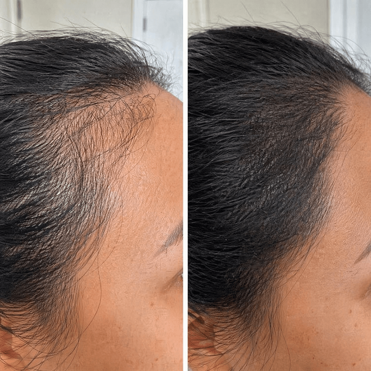 Resultado real 05 Renova Therapy